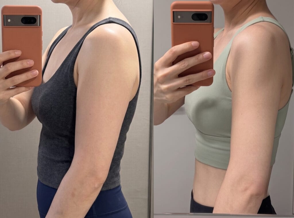 Before and after results of targeted arm liposuction in Korea at 1 month post-op, demonstrating significant upper arm fat reduction and smooth skin contouring coordinated by Korea Beauty Guide.