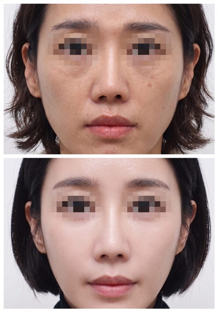 Before and after photo of full face fat grafting in Korea. A female patient showing natural facial volume restoration, improved skin contour, and reduction of nasolabial folds using stem cell fat transfer.