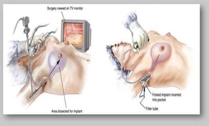 Medical diagram showing a high-definition endoscope being used during breast augmentation surgery to visualize internal tissue and ensure precise pocket dissection in a Seoul clinic.