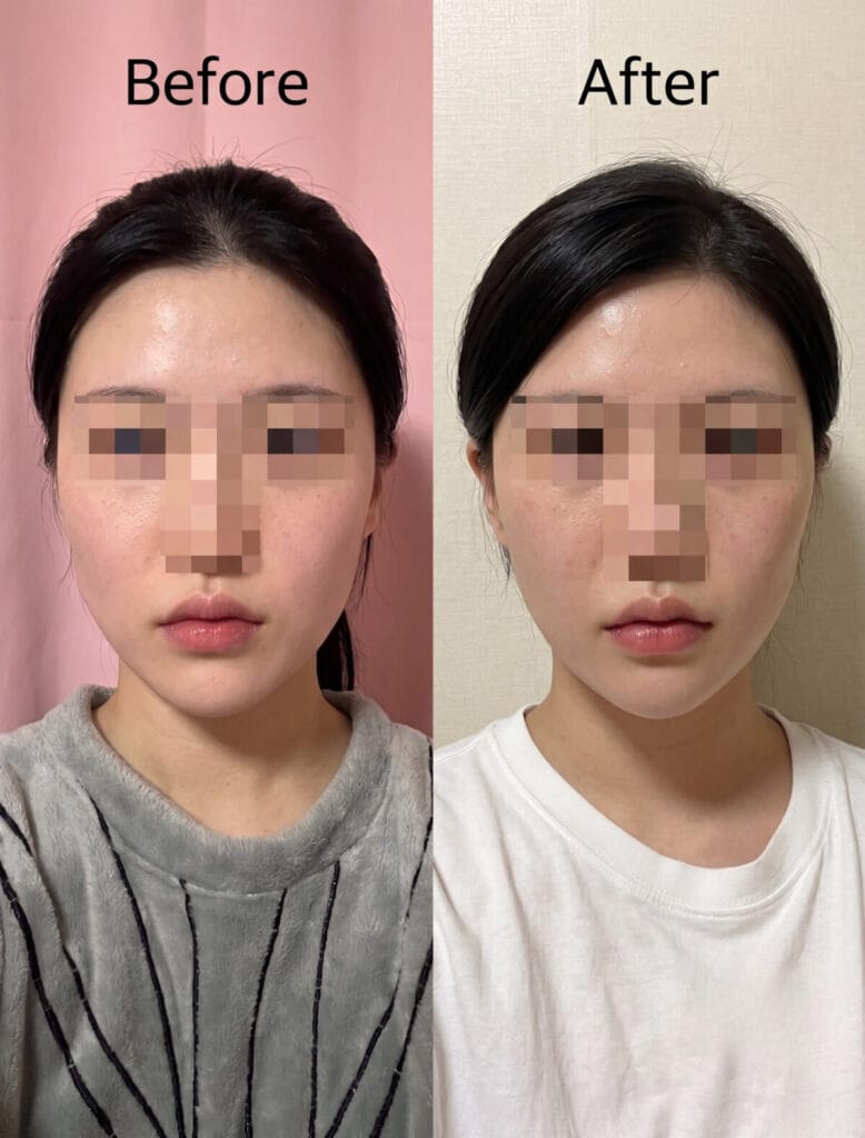 Before and after photos of a square jaw reduction procedure in South Korea, showing a natural V-line contour safely achieved through a long-curve ostectomy.