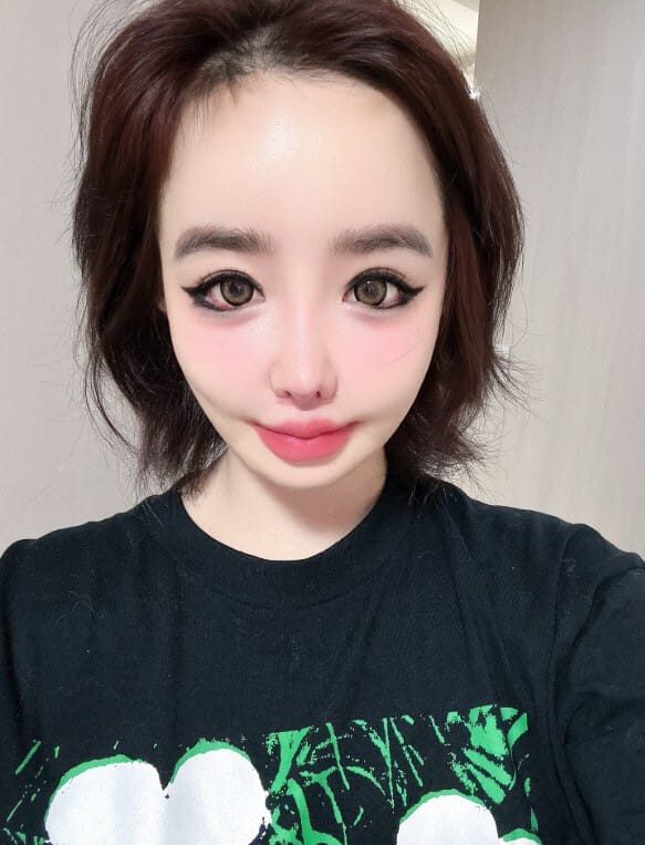 Singer Park Bom serving as a clinical example of the risks associated with excessive cosmetic procedures and loss of facial harmony.